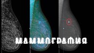 Mammography BI RADS МУСТАФИН ЧИНГИС 79104653497 КУРС МАММОЛОГИИ
