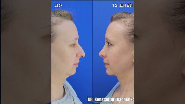 Коррекция подбородка и ринопластика