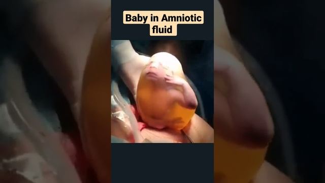 Baby in Amniotic cavity outside womb #baby #medical #womb #top #best #alive #surgery #csection