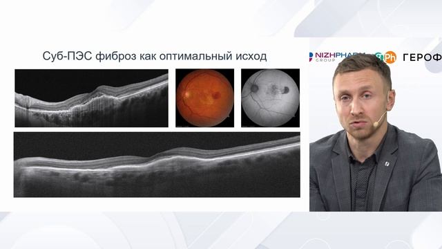 ОКТ биомаркеры для персонализированного лечения пациентов с ВМД. Мальцев Д.С.,