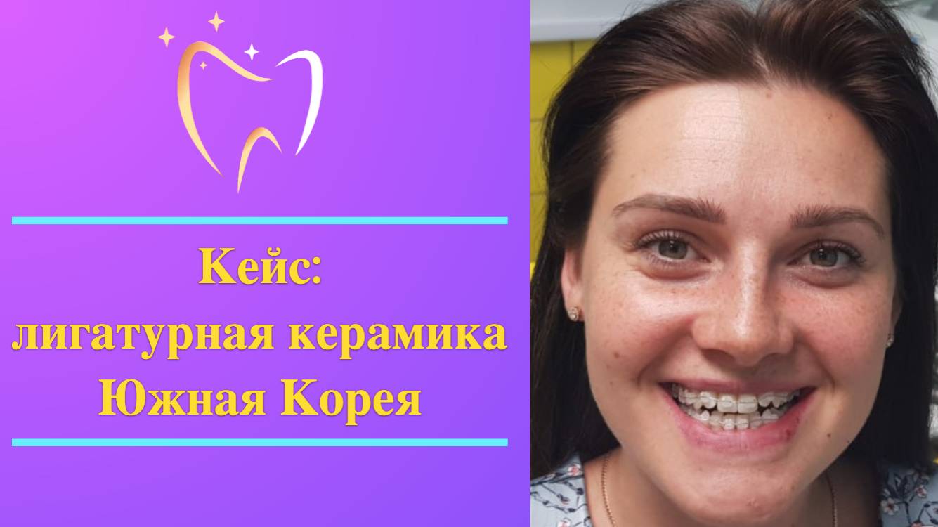 💫 Кейс: лигатурная керамика Южная Корея