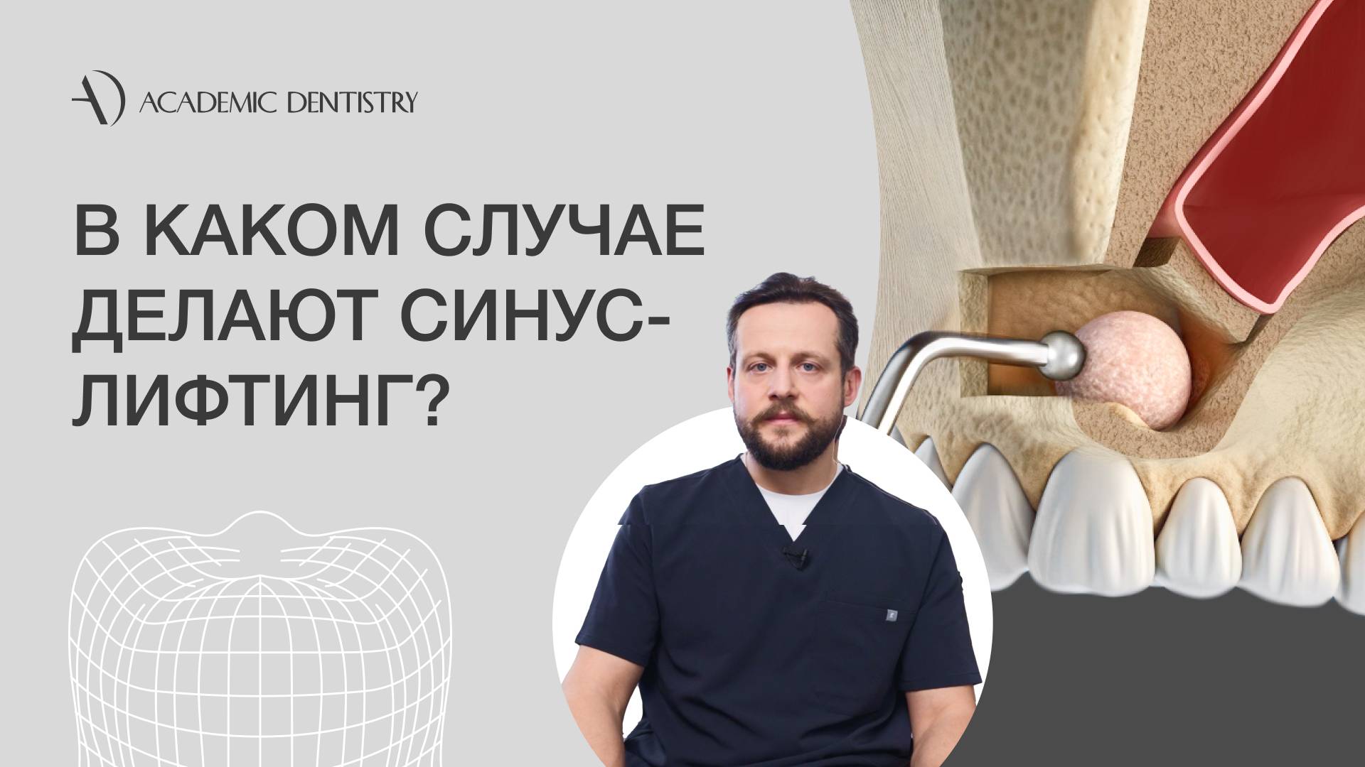 Когда необходим синус-лифтинг при имплантации зубов?