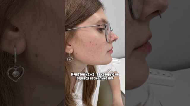 #чистая_кожа #акне #яврач 
подробнее по ссылкам ⬇️https://vk.com/mikclinik
https://vk.com/dr.muk.mp4