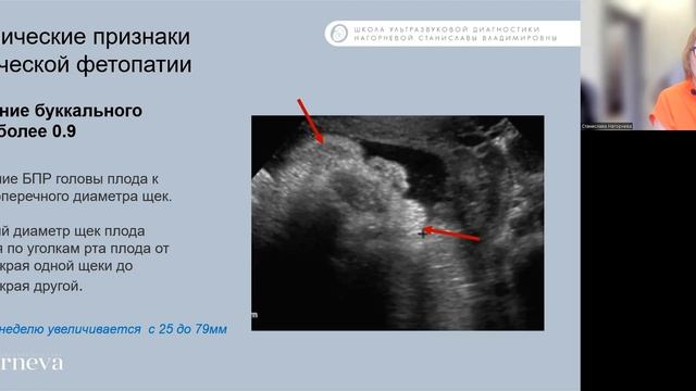 3.3 Лекция №7.Макросомия