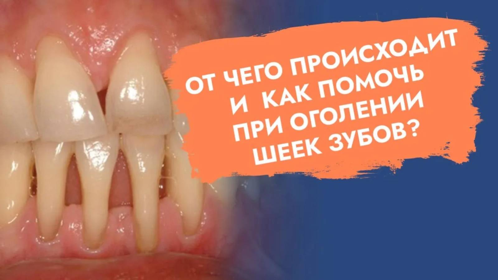 Почему оголяются корни зубов? К кому идти?