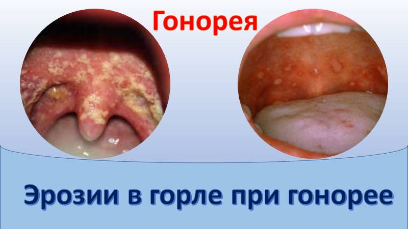 Эрозии в горле при гонорее