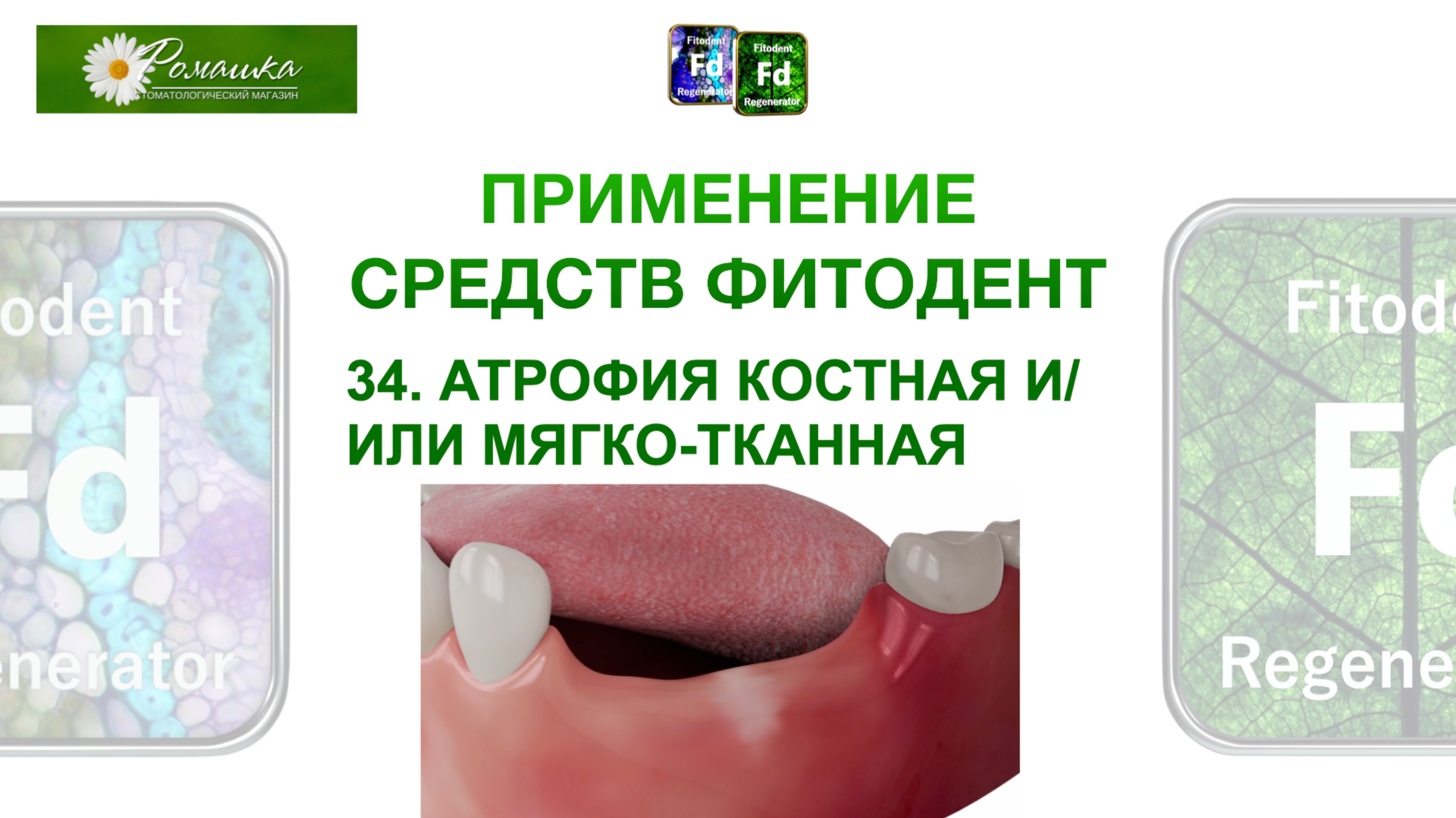 Применение средств Фитодент №34 Атрофия костная и/или мягко-тканная