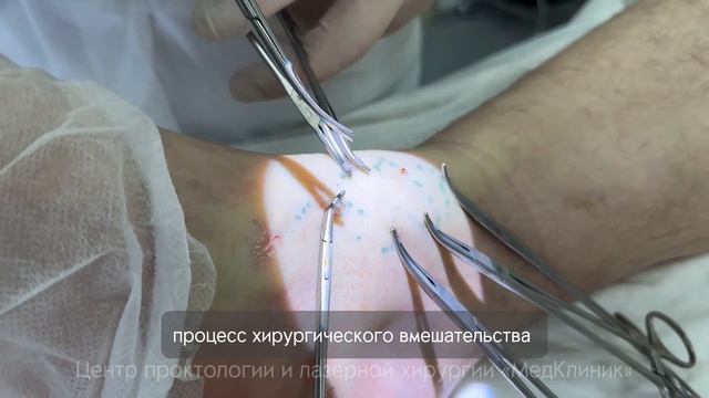 МИНИФЛЕБЭКТОМИЯ по Варади: этапы выполнения операции