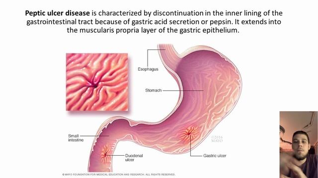 Definition of Peptic Ulcer Disease