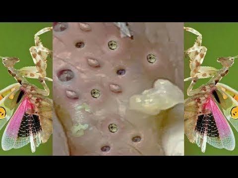 Relax squeezing out blackheads #22 Черные точки