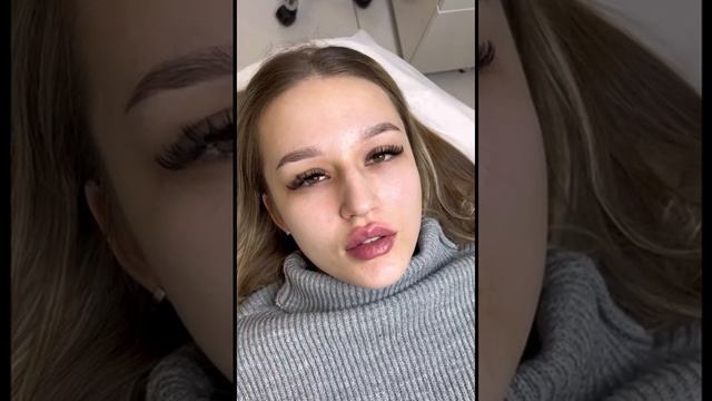 Увеличение (аугментация) губ в Томске