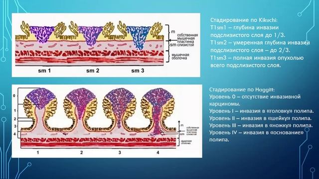 ИГМУ_Кафедра_онкологии_и_лучевой_терапии. Рак толстой кишки