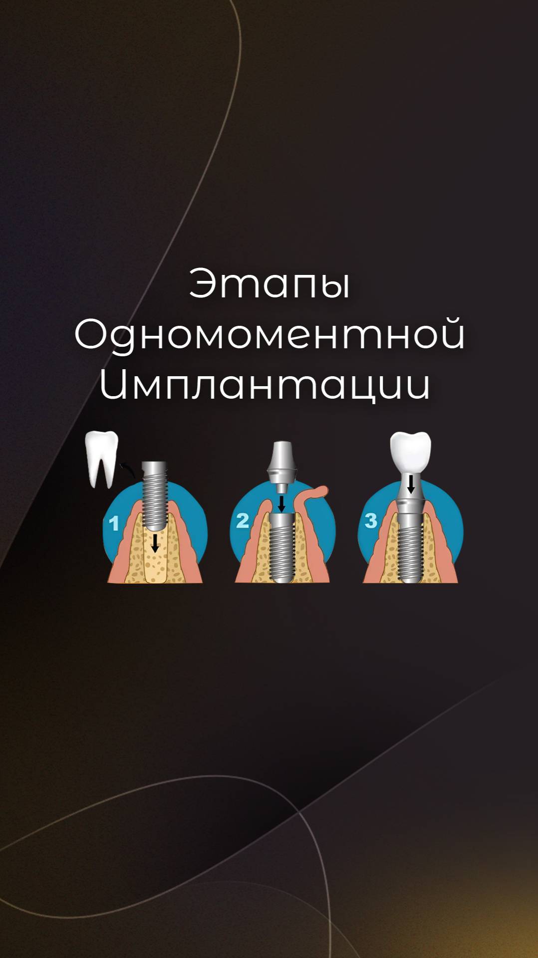Этапы одномоментной имплантации #AlconDentalClinic #СтоматологияНаСоколе #ОдномоментнаяИмплантация