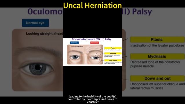 Uncal Herniation