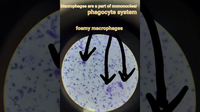 Macrophage#inflammation# immune system# Pathology#Cytology smear