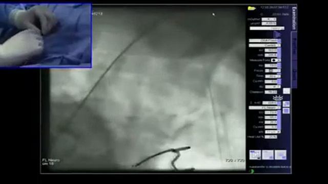 Percutaneous Intervention of Proximal Left-Subclavian Artery - March 28, 2012 Live Case Video
