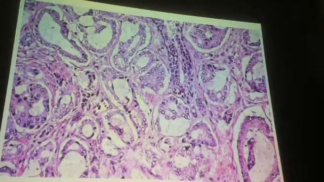 PATOLOGÍA-CÁNCER DE PRÓSTATA-PARTE 1-DR MONGE