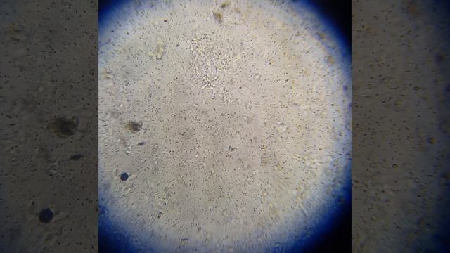 Sperm under microscope 15 months post vasectomy reversal