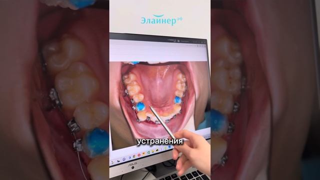 РАЗБОР КЛИНИЧЕСКОГО СЛУЧАЯ ОТ ВРАЧА-ортодонта #исправлениеприкуса #детскаястоматология #москва #зуб