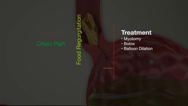 Achalasia Treatment with Endoscopic Balloon Dilation