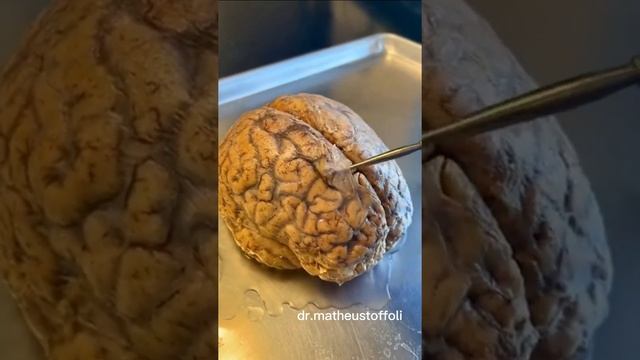 Meninges do cérebro