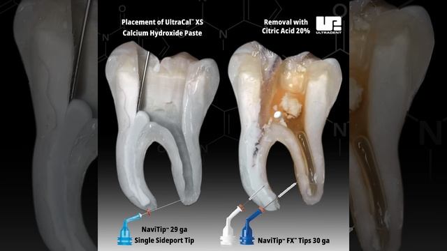 UltraCal™ XS placement and removal with Citric Acid 20%