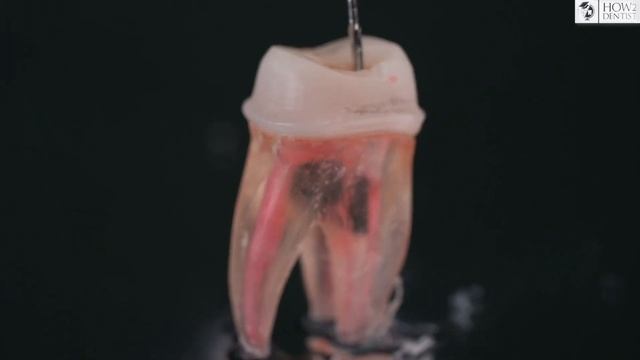 How to restore a tooth after endodontic treatment. Theory / How to Dentist