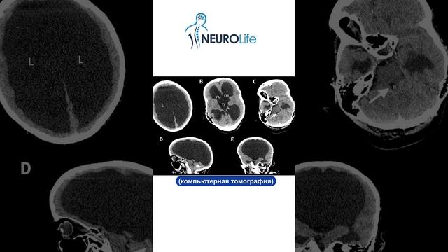 Диагностика гидроцефалии | Gidrosefaliya diagnostikasi | NeuroLife | Davron Kadirov