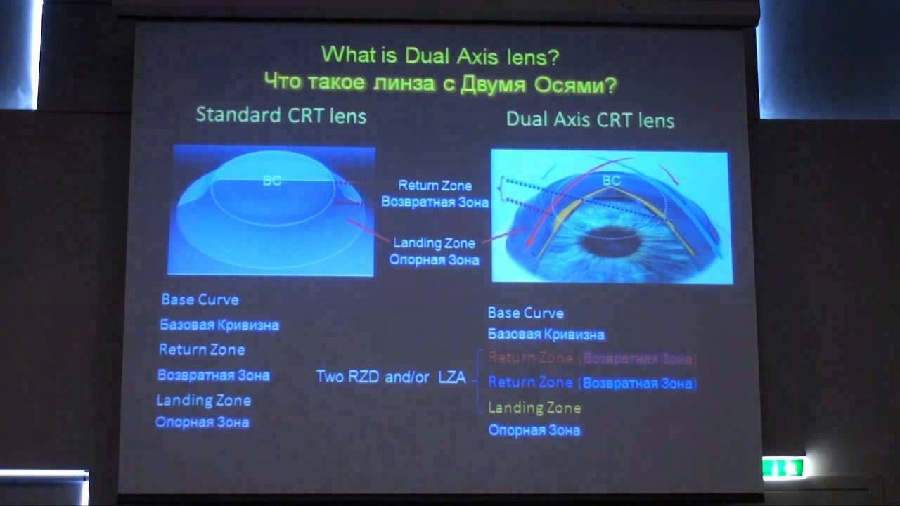 Advances In Corneal Reshaping Associated With Corneal Astigmatism – PAGORAN CRT DUAL AXIS DESIGN