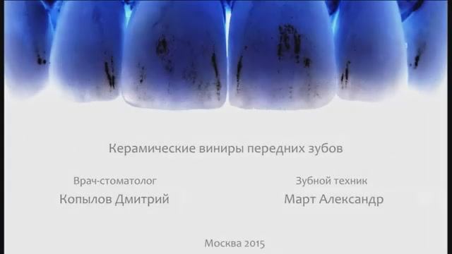 Керамические виниры. Porcelain veneers. Emax. Carillas Dentales.