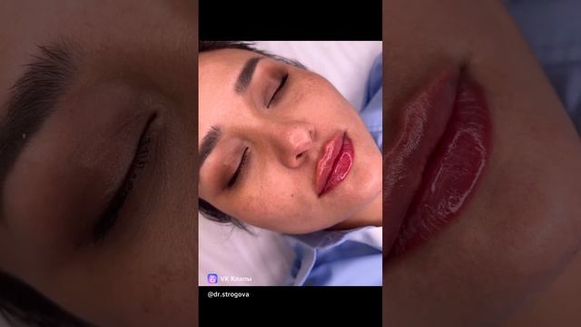 Максимально гармоничное увеличение губ 💋
для моей пациентки из Волгограда. Спасибо за доверие ❤️