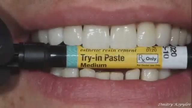 Виниры без обточки зубов. Veneers without teeth preparation. Emax. Carillas Dentales.
