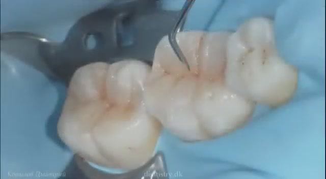 Реставрация боковых зубов композитом Capo Natural. Posterior teeth restoration