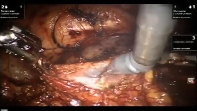 Dr. Manav Suryavanshi: Robotic Ureteric Reimplantation Intraperitoneal Replication