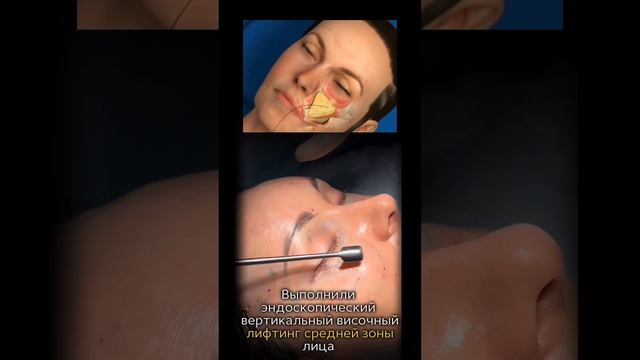 Комплексная операция лица