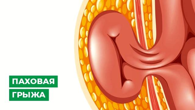 Паховая грыжа