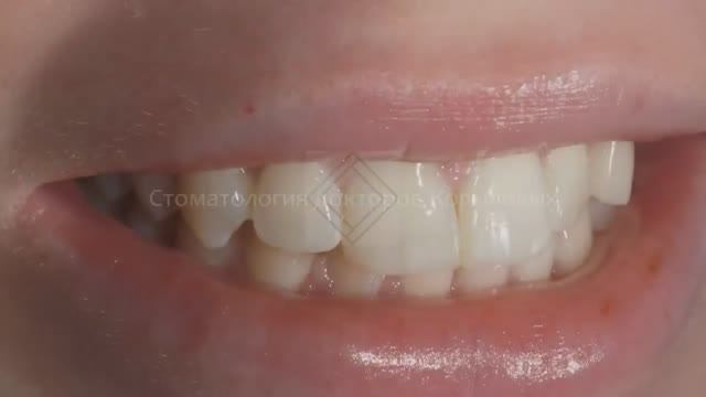Прямая и полупрямая реставрация передних зубов композитом. iGos и Esthet-X. Front teeth restoration.