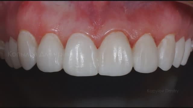 Керамические виниры без препарирования. Люминиры. Emax. Non prep veneers