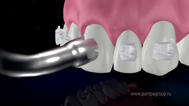Дебондинг брекетов QuicKlear c керамической крышкой