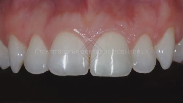 Внутреннее отбеливание зуба и домашнее отбеливание зубов. Teeth whitening.