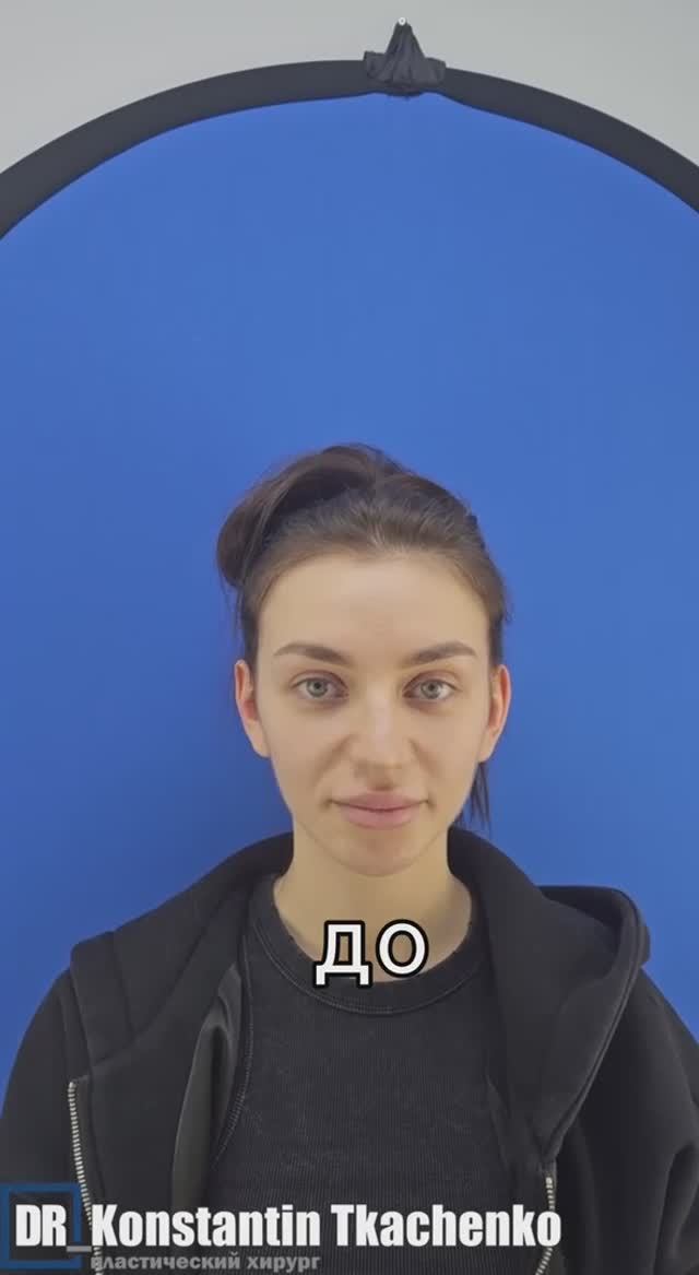 Отопластика - коррекция ушных раковин.