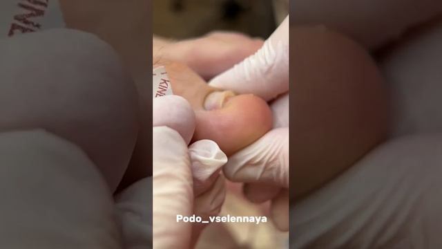 Титановая нить.