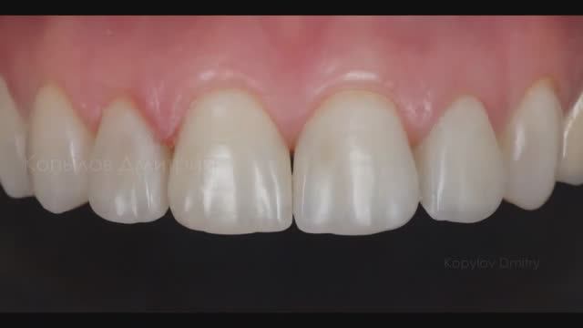 Реставрация передних зубов. Front teeth restoration. Capo Natural (Schutz).
