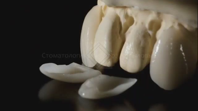 Керамические виниры без препарирования. ч.2. Люминиры. Ceramic veneers without preparation.