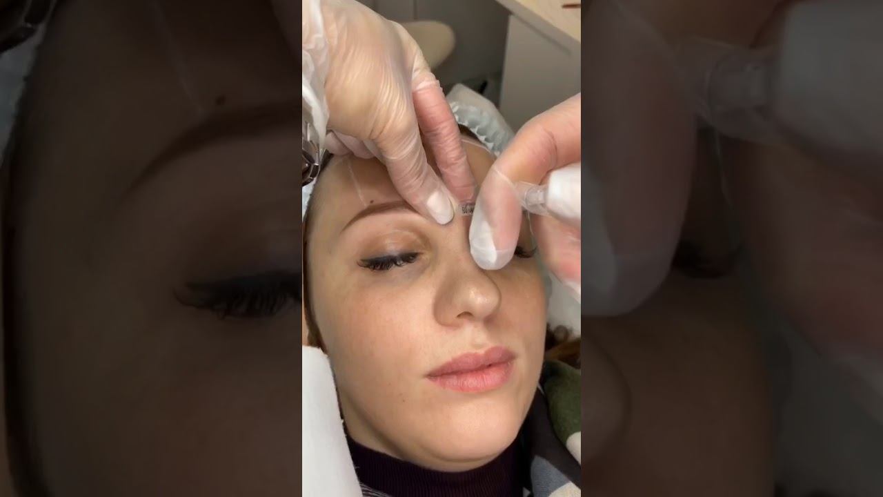 Ботокс (ботултнотерапия) в Venezia Clinic