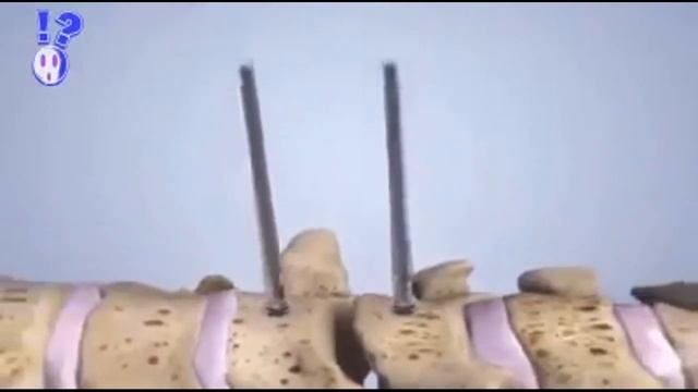A herniated disc  and his replacement. Выпадение диска и его замена