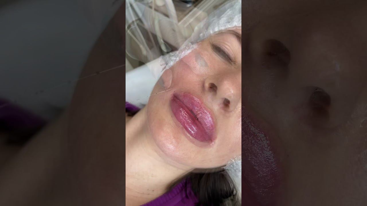 Заполнение носогубных складок в Venesa Clinic (клиника Венес)