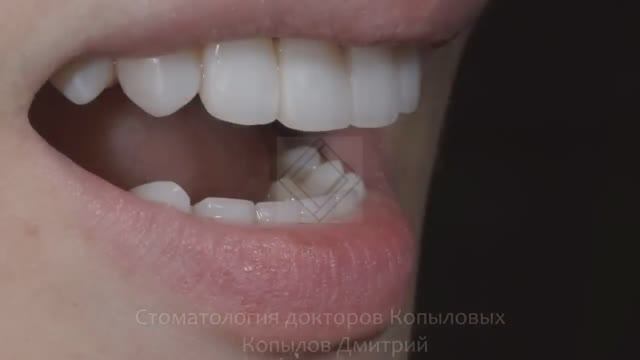 Лечение стираемости зубов. Реставрация зубов по силиконовому ключу. Front teeth restoration.