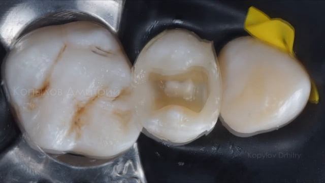 Реставрация бокового зуба композитом. Posterior tooth restoration. OliCo XP. (1)