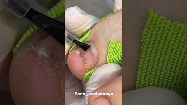 Сломался ноготь. Что делать?